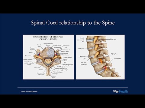 Multiple Sclerosis and the Spinal Cord